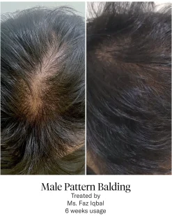 Advanced Hair System Kit Traitement de Régénération Capillaire