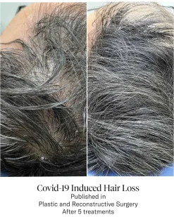 Advanced Hair System Kit Traitement de Régénération Capillaire