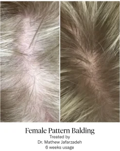 Advanced Hair System Kit Traitement de Régénération Capillaire