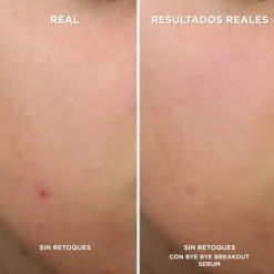 Bye Bye Breakout Serum